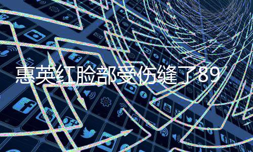 惠英紅臉部受傷縫了89針，經(jīng)歷令人震驚