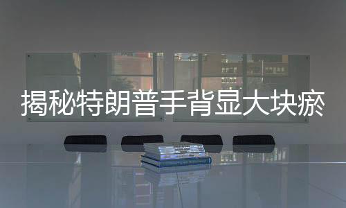 揭秘特朗普手背顯大塊瘀傷背后的故事，白宮官方解釋與爭議