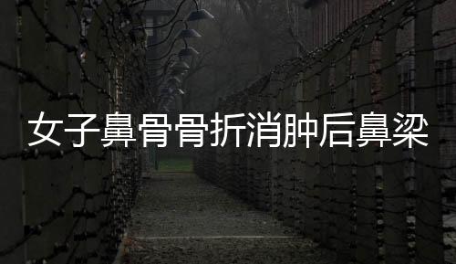 女子鼻骨骨折消腫后鼻梁高挺，重拾自信美