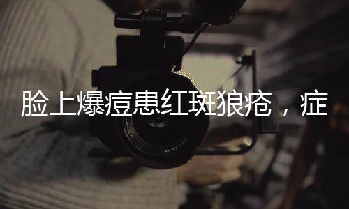 臉上爆痘患紅斑狼瘡，癥狀解析與應(yīng)對(duì)之道